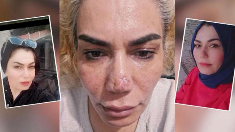 Estetik Ameliyatı Sonrası Mduriyet Yaşayan Kadın, Doktoruna ve Klinike Soruşturma Açtı